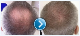 Hair transplant